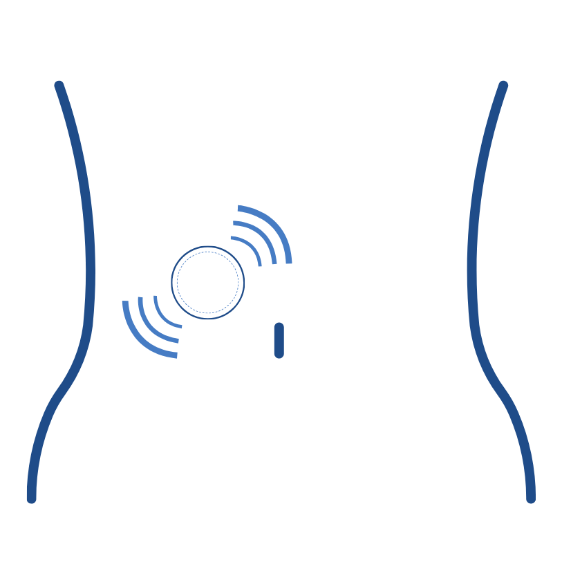 Pain Morphine Pump Implant and Delivery