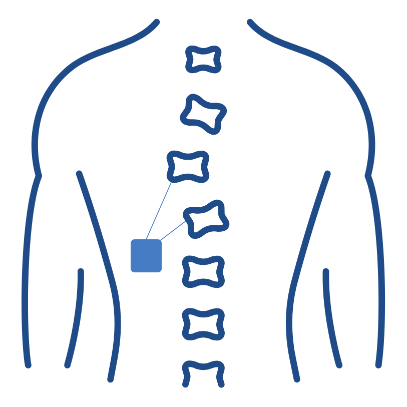 Spinal Cord Stimulator Implant